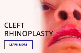 Cleft Rhinoplasty