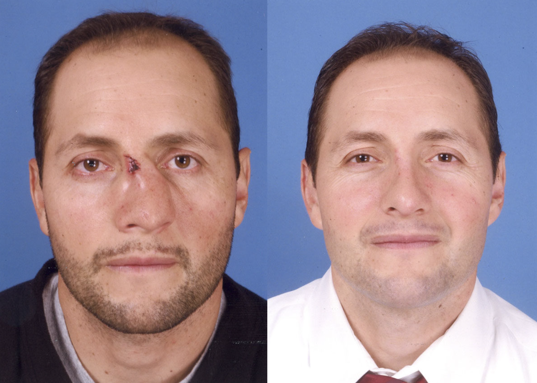 Rhinoplasty - Before and After Photo Performed by James P. Bradley, MD in New York City