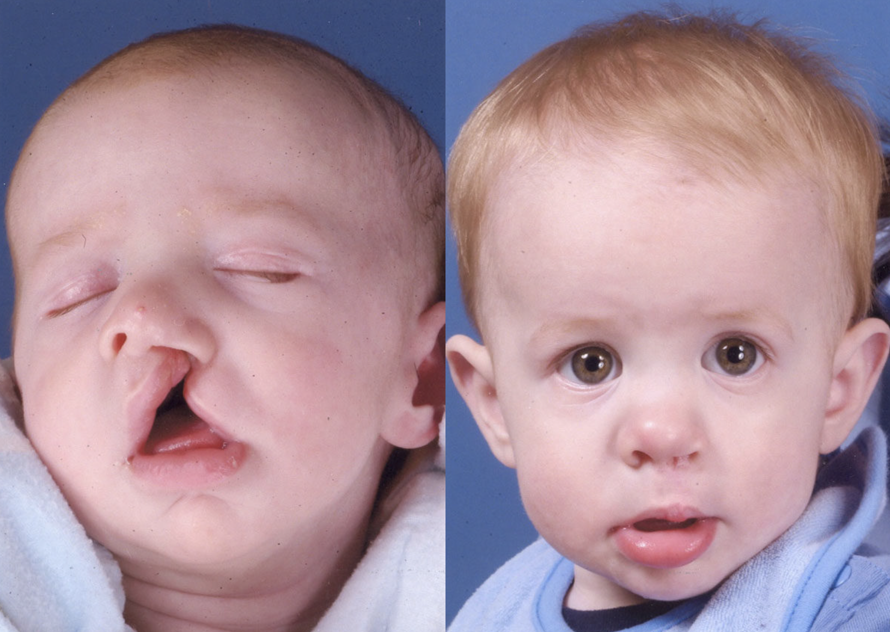 Cleft Lip - Before and After Photo Performed by James P. Bradley, MD in New York City