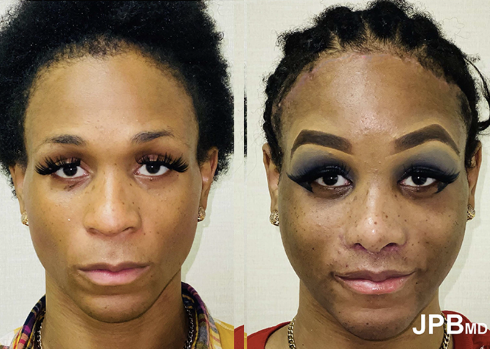 Facial Feminization Before Afters James P Bradley Md