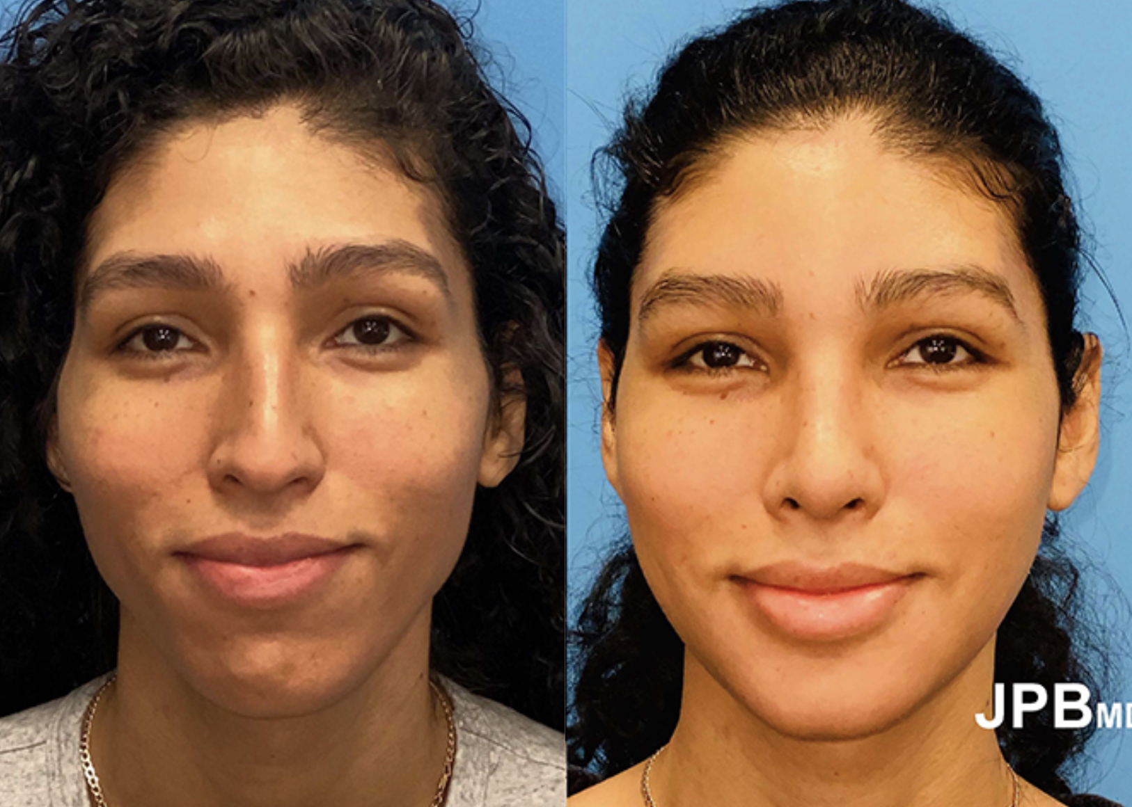 Facial Feminization Surgery Patient - Before and After Photo Performed by James P. Bradley, MD in New York City