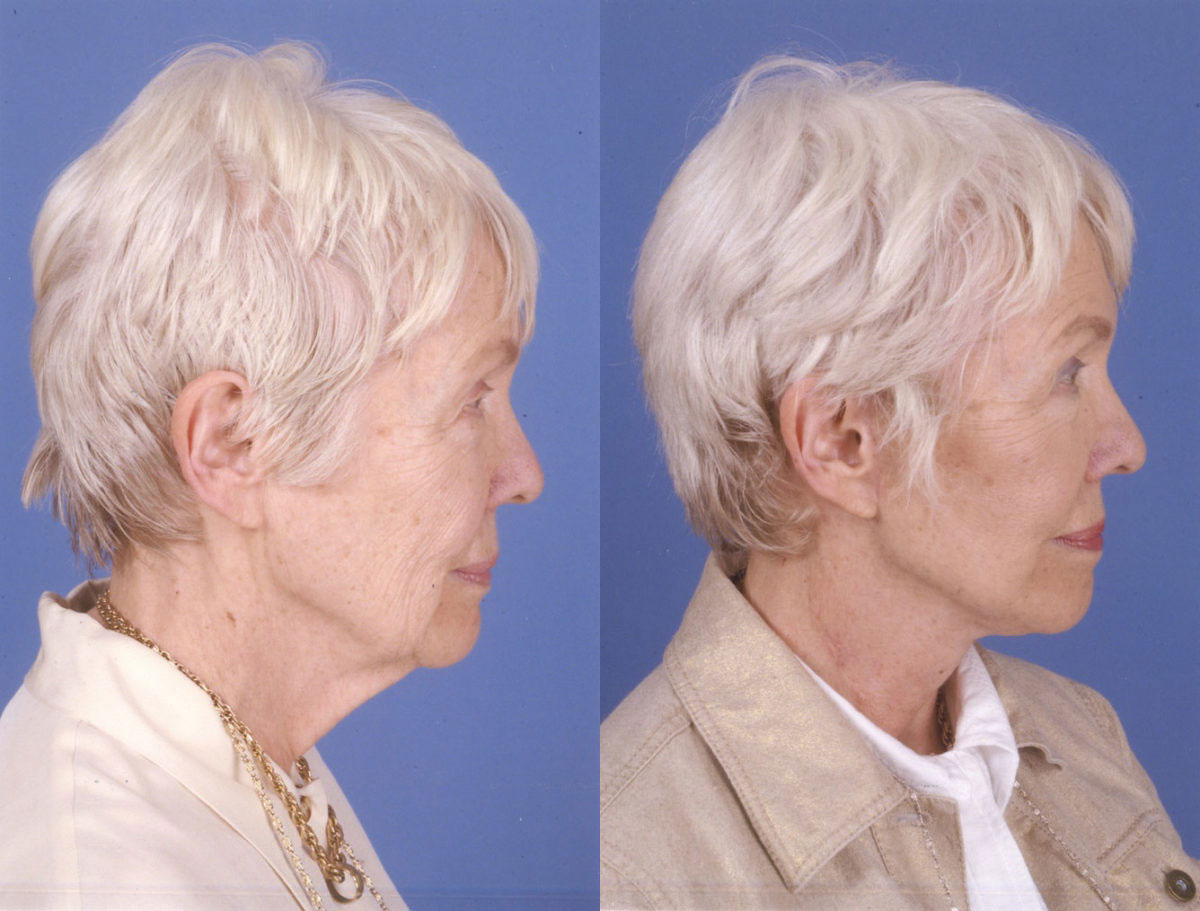 Facelift - Before and After Photo Performed by James P. Bradley, MD in New York City