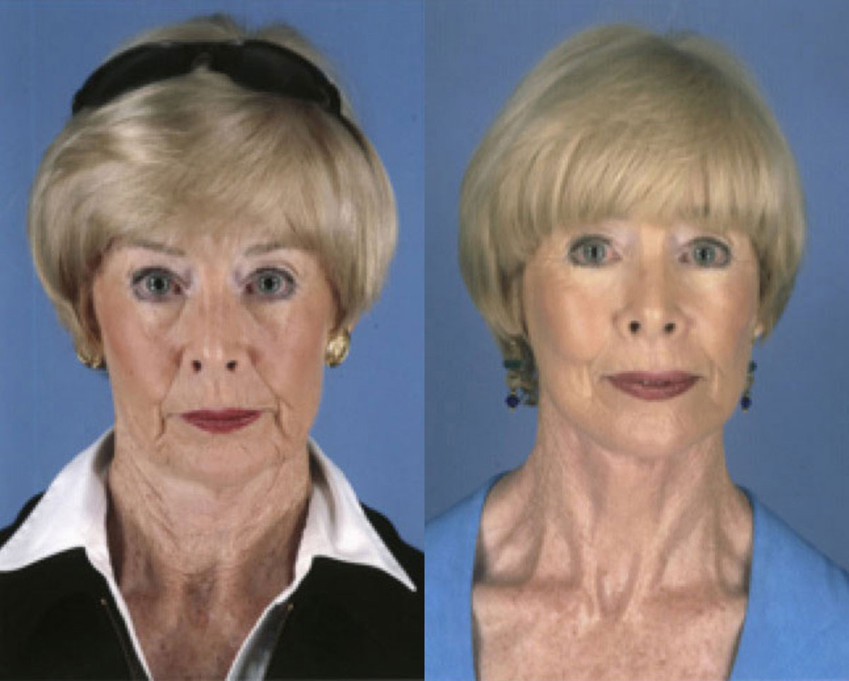 Facelift - Before and After Photo Performed by James P. Bradley, MD in New York City