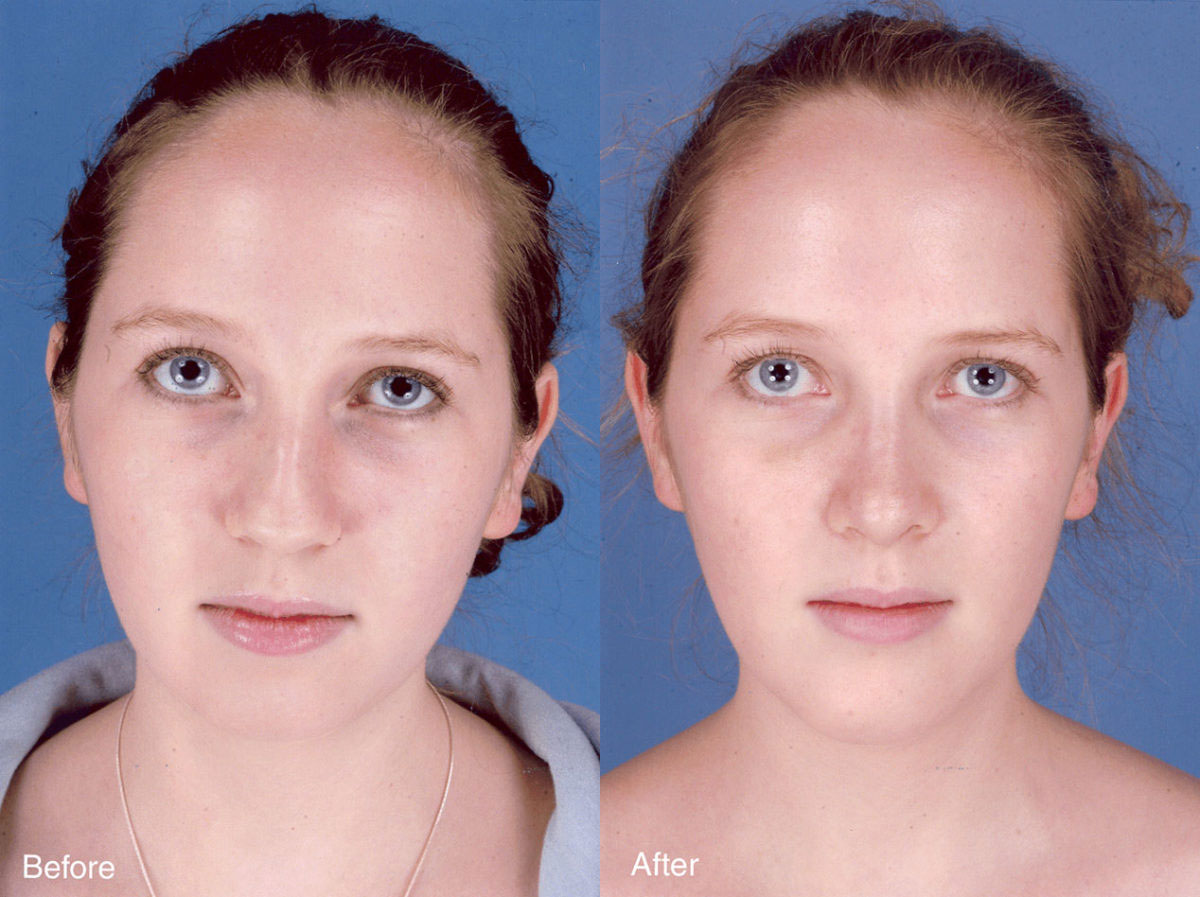 Rhinoplasty - Before and After Photo Performed by James P. Bradley, MD in New York City