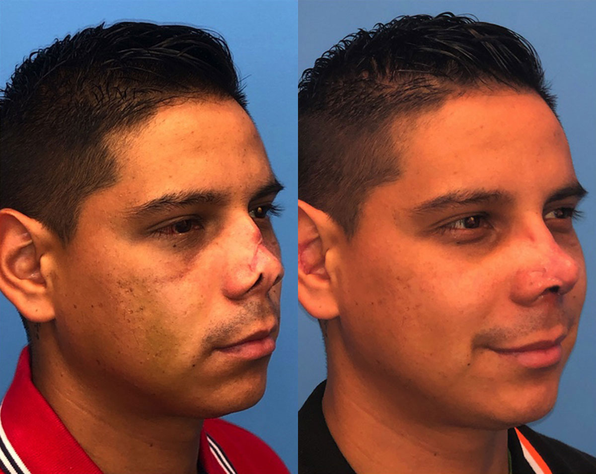Rhinoplasty - Before and After Photo Performed by James P. Bradley, MD in New York City
