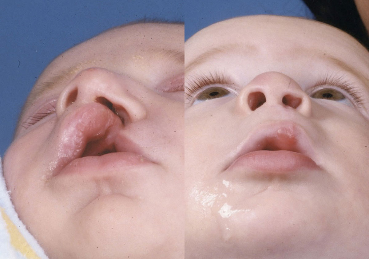 Cleft Lip - Before and After Photo Performed by James P. Bradley, MD in New York City