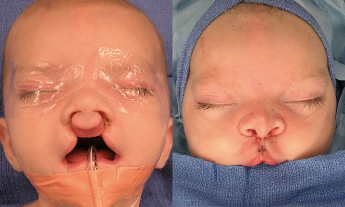 Cleft Lip - Before and After Photo Performed by James P. Bradley, MD in New York City