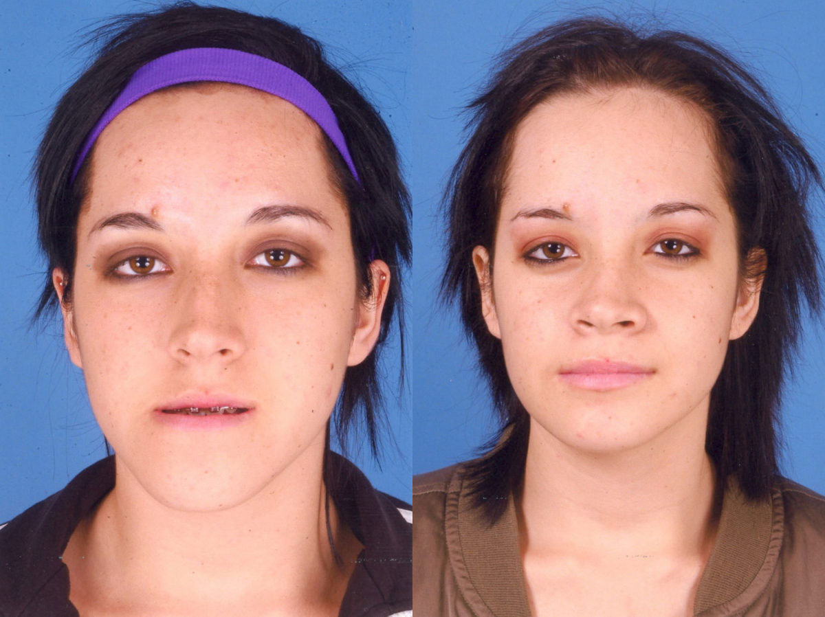 Jaw Surgery - Before and After Photo Performed by James P. Bradley, MD in New York City