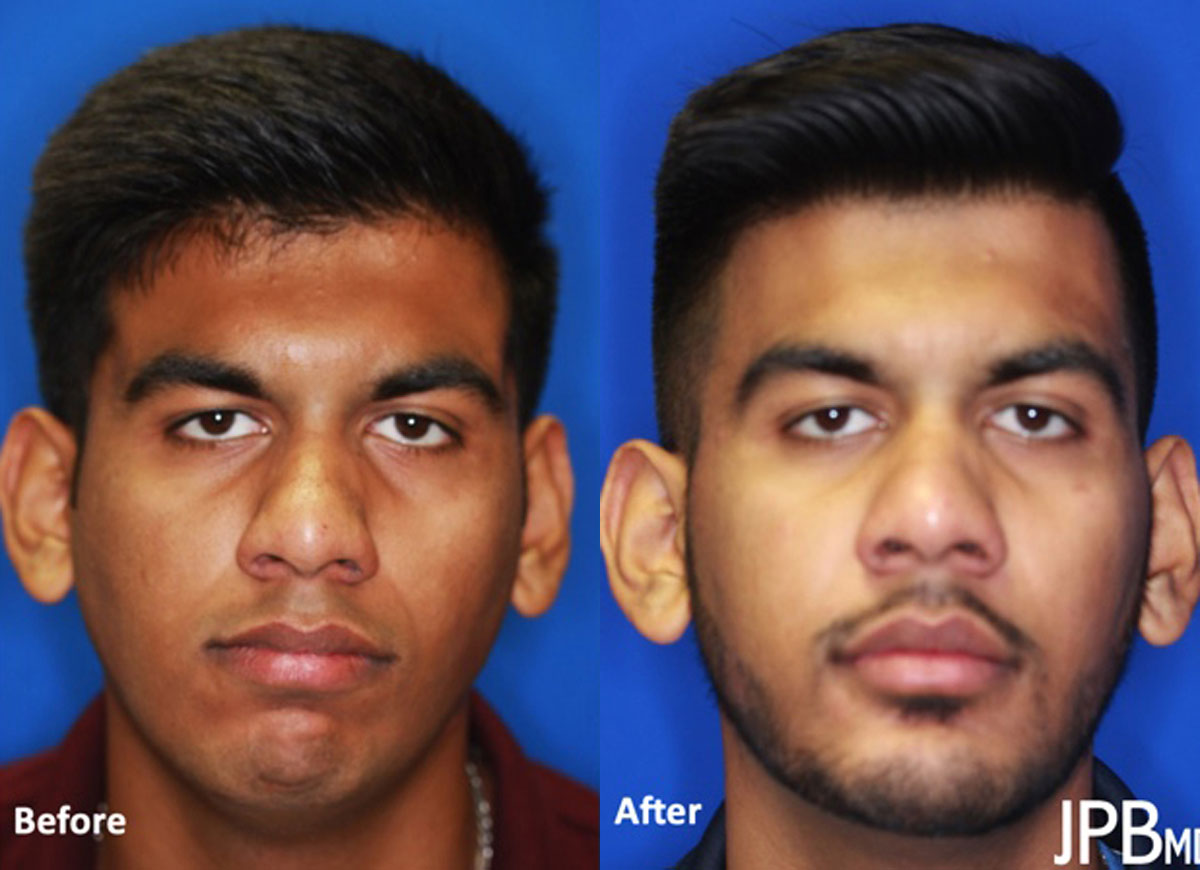 Jaw Surgery - Before and After Photo Performed by James P. Bradley, MD in New York City