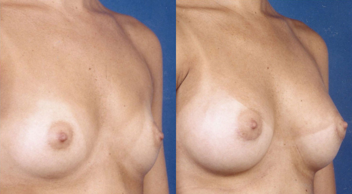 Breast Augmentation - Before and After Photo Performed by James P. Bradley, MD in New York City