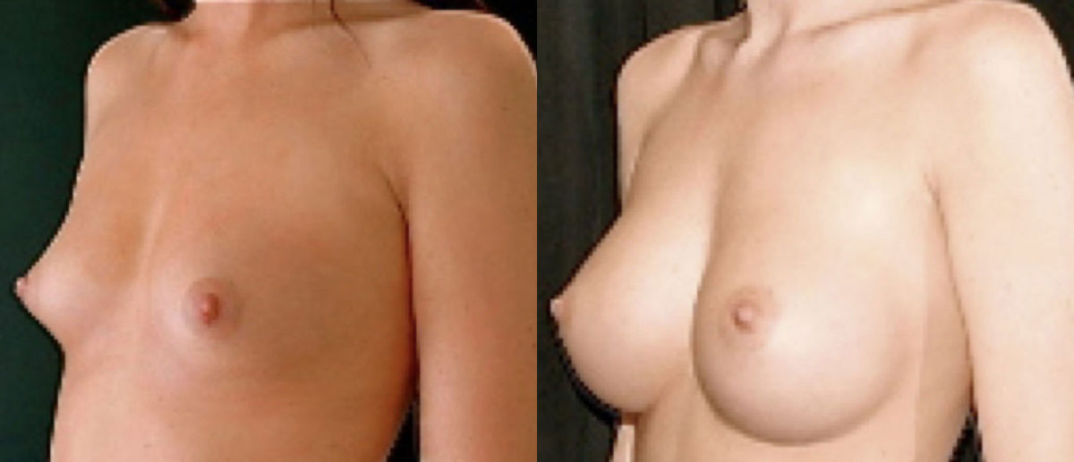 Breast Augmentation - Before and After Photo Performed by James P. Bradley, MD in New York City