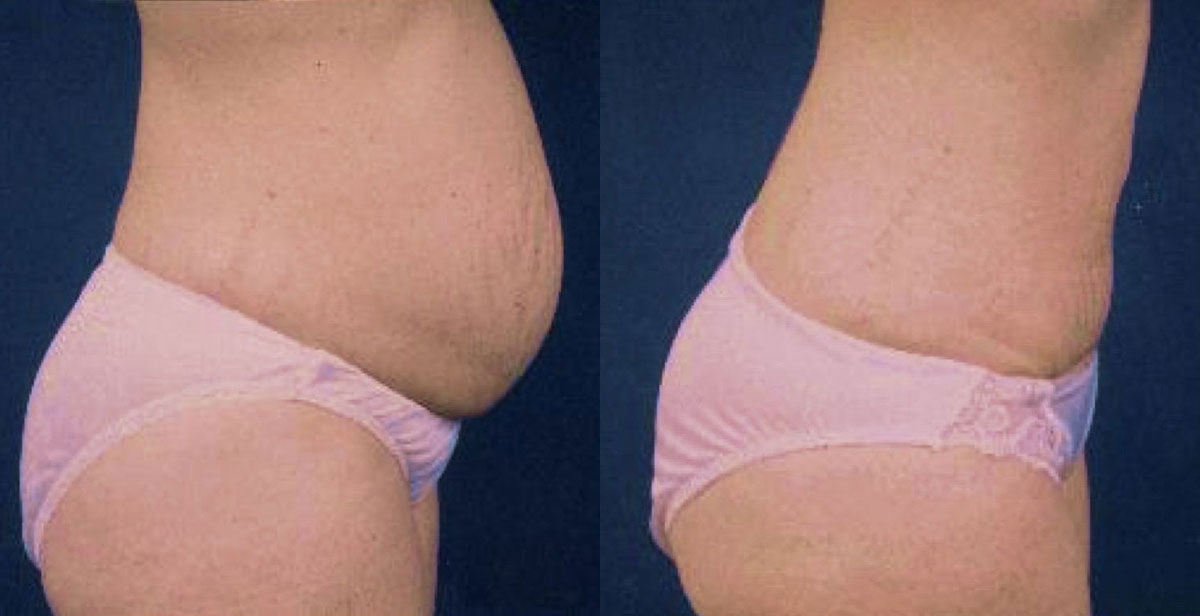 Abdominoplasty - Before and After Photo Performed by James P. Bradley, MD in New York City