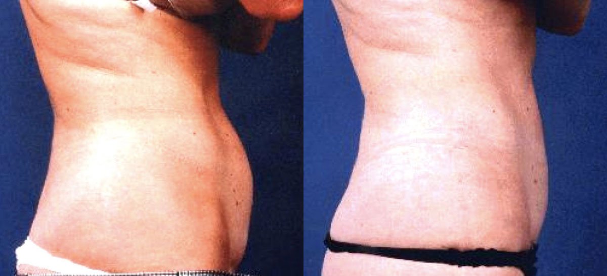 Abdominoplasty - Before and After Photo Performed by James P. Bradley, MD in New York City