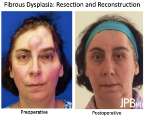 Fibrous Dysplasia