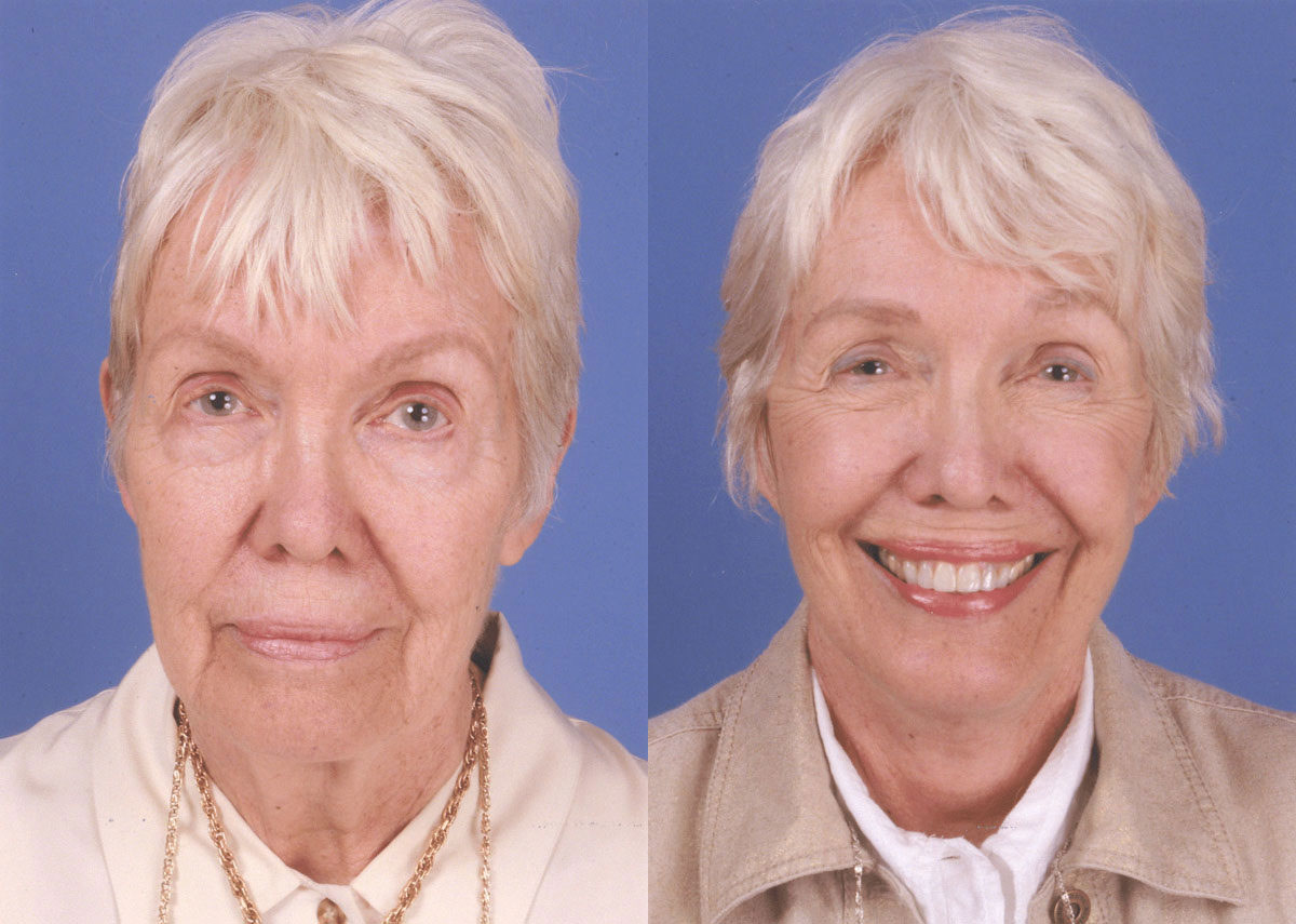 Facelift Result New York