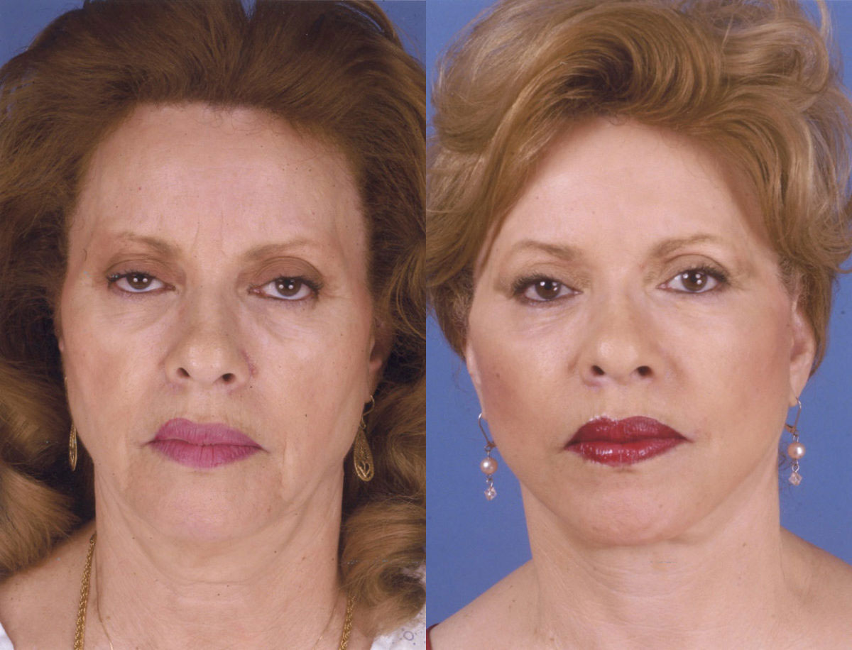 Facelift Result New York