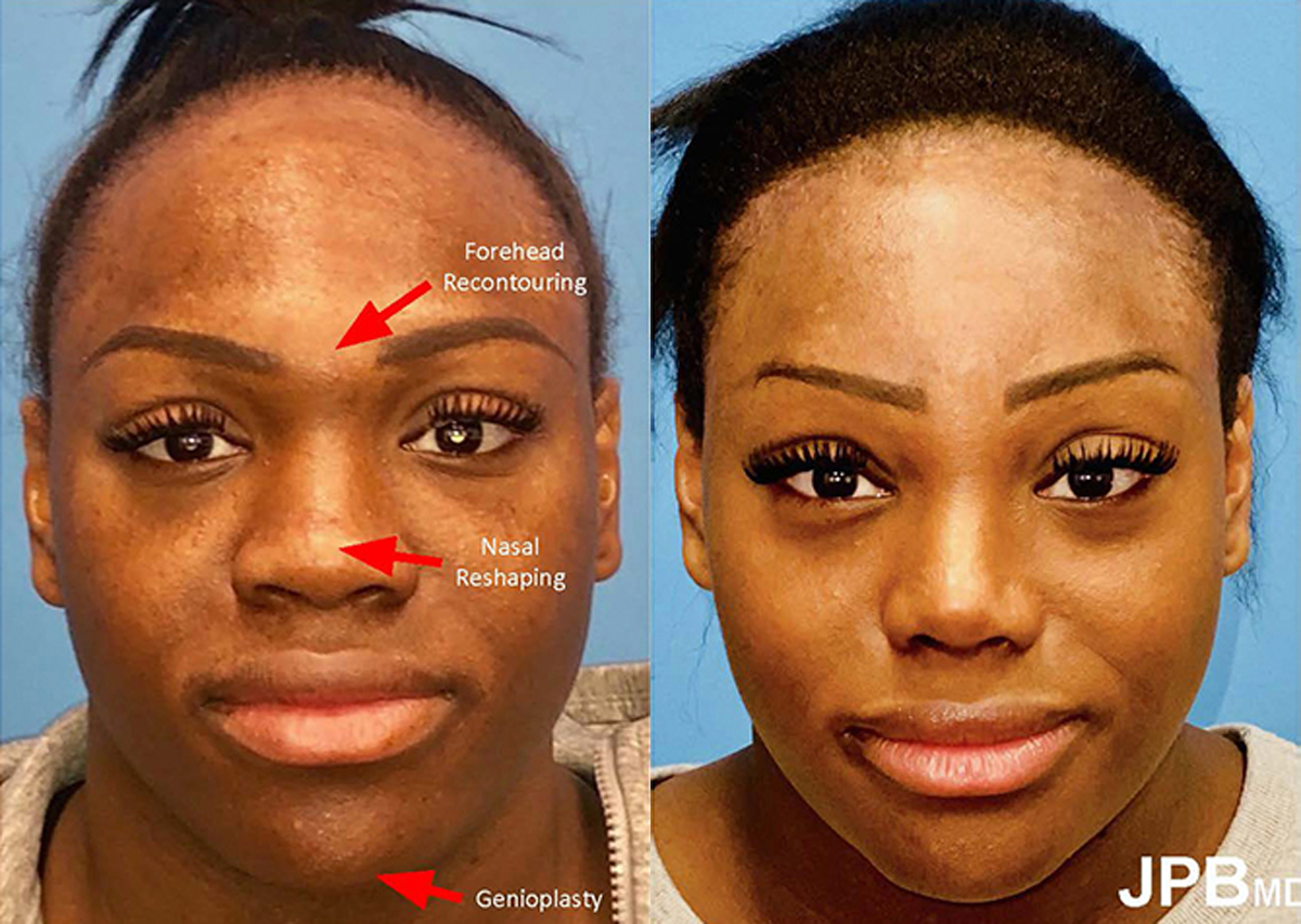 Facial Feminization Surgery Patient - Before and After Photo Performed by James P. Bradley, MD in New York City