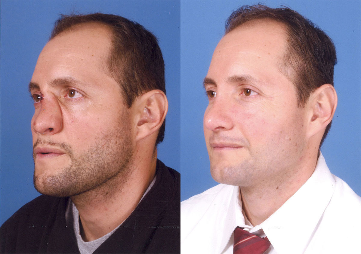 Rhinoplasty - Before and After Photo Performed by James P. Bradley, MD in New York City