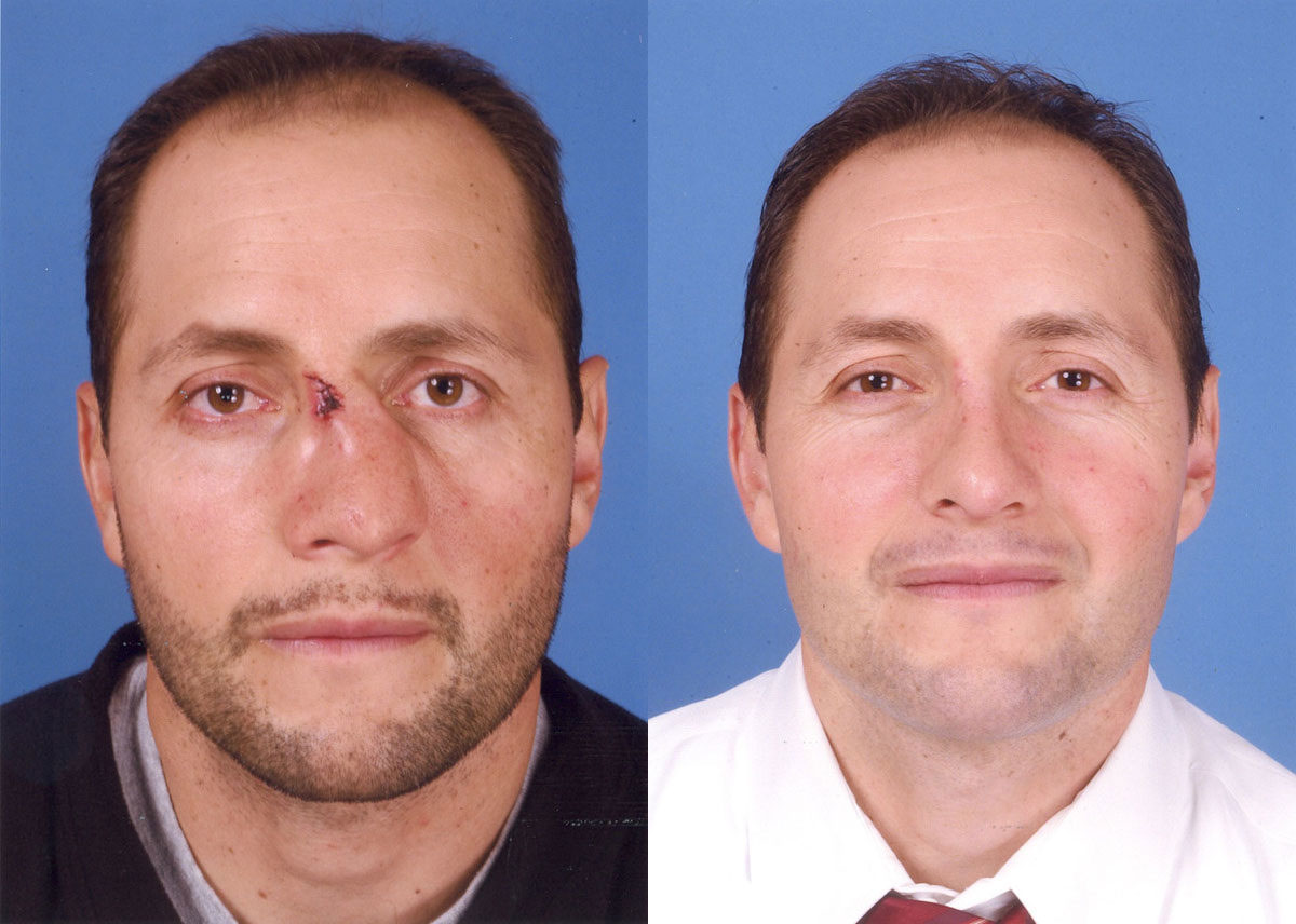 Rhinoplasty - Before and After Photo Performed by James P. Bradley, MD in New York City