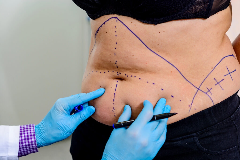 Why Combine Liposuction with Tummy Tuck Surgery?