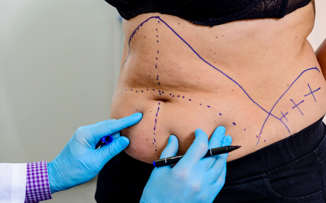 The Benefits of Combining Liposuction with Tummy Tuck Surgery