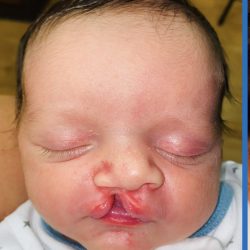Cleft Lip Before & After Patient #2169