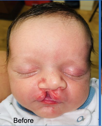 Cleft Lip Before & After Patient #2169
