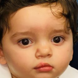 Cleft Lip Before & After Patient #2169