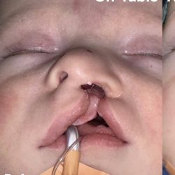 Cleft Lip Before & After Patient #2175