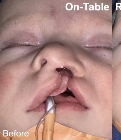 Cleft Lip Before & After Patient #2175