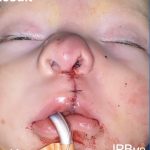 Cleft Lip Before & After Patient #2175