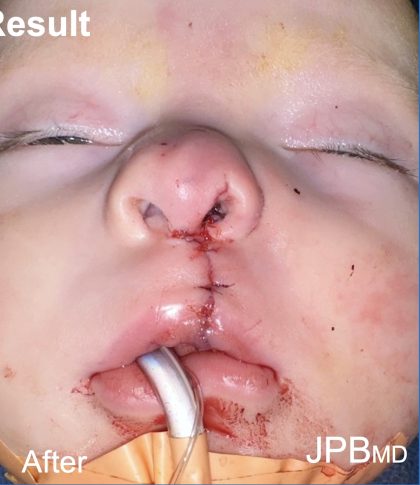 Cleft Lip Before & After Patient #2175