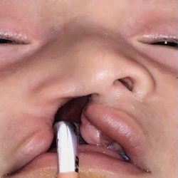 Cleft Lip Before & After Patient #2176