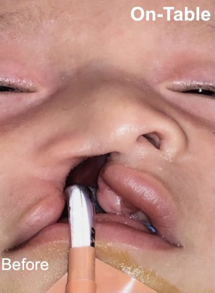 Cleft Lip Before & After Patient #2176