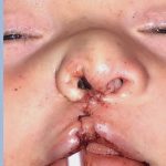 Cleft Lip Before & After Patient #2176