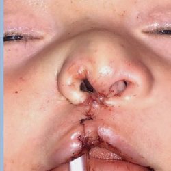 Cleft Lip Before & After Patient #2176