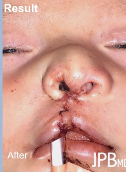 Cleft Lip Before & After Patient #2176