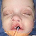 Cleft Lip Before & After Patient #2177