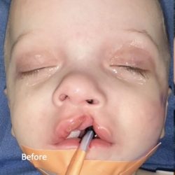 Cleft Lip Before & After Patient #2177
