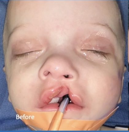 Cleft Lip Before & After Patient #2177