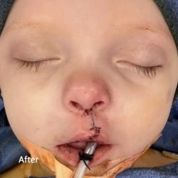 Cleft Lip Before & After Patient #2177