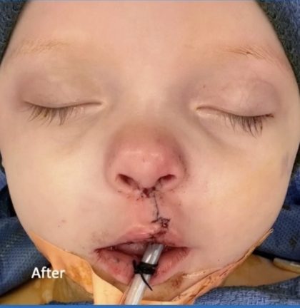 Cleft Lip Before & After Patient #2177