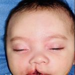 Cleft Lip Before & After Patient #2170