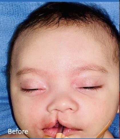 Cleft Lip Before & After Patient #2170