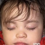 Cleft Lip Before & After Patient #2170