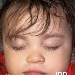 Cleft Lip Before & After Patient #2170