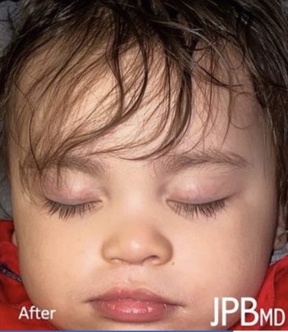 Cleft Lip Before & After Patient #2170
