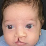 Cleft Lip Before & After Patient #2171