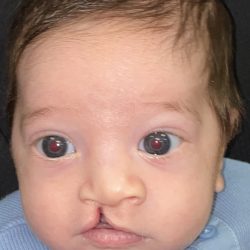 Cleft Lip Before & After Patient #2171