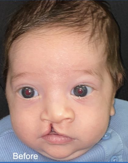 Cleft Lip Before & After Patient #2171